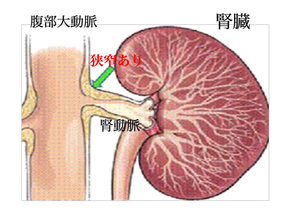 動脈 狭窄 腎